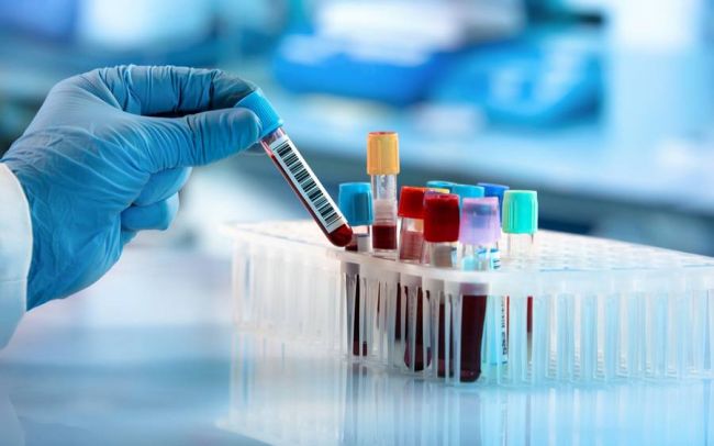 blood_test_samples_1200x75059cd6b99366c6e716576ccd68351ed39.jpg